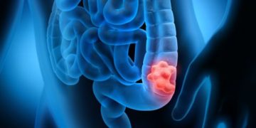 E. coli gut infection linked to bowel cancer